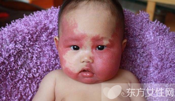 胎記是怎么形成的 胎記對命運也是有影響的哦