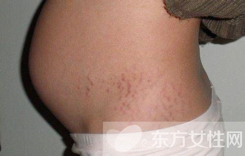 如何預(yù)防妊娠紋 最經(jīng)濟(jì)有效的祛除妊娠紋方法推薦