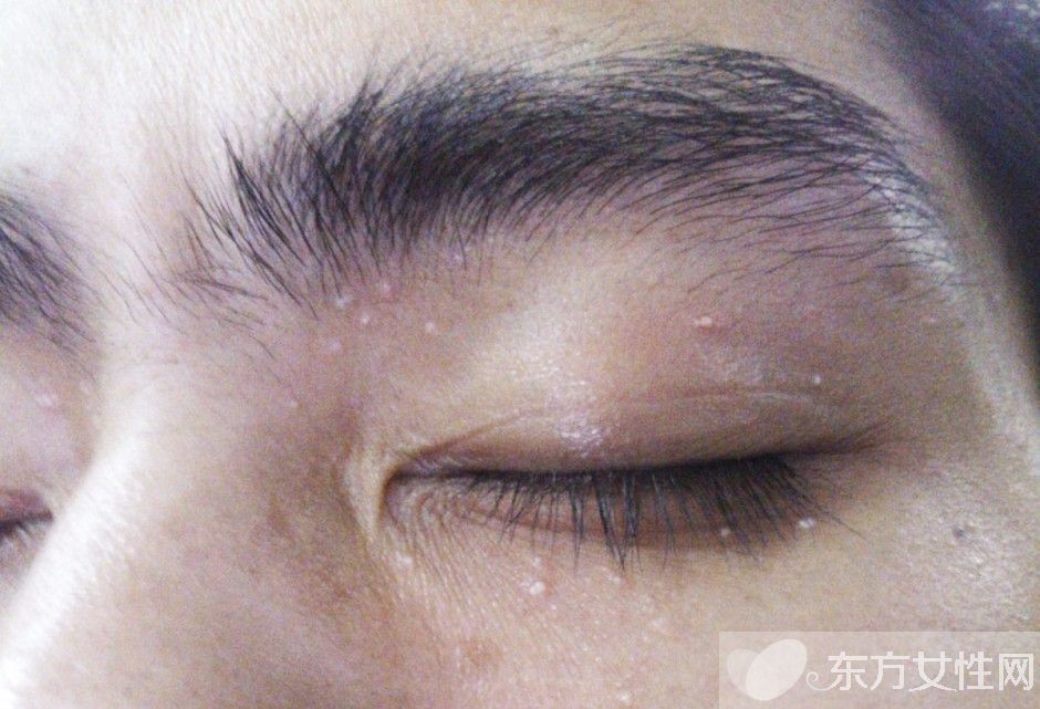 脂肪粒怎么去除小竅門 脂肪粒居然是這么來的