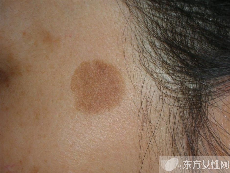 老年斑怎么去除 這些日常祛斑小竅門(mén)你記住了嗎