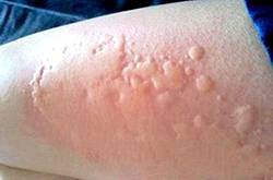 海鮮過敏怎么辦 預防海鮮過敏的方法