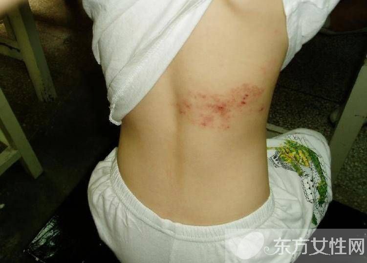 蛇盤(pán)瘡的最佳治療方法 這些早期癥狀需注意