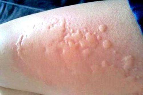 海鮮過敏怎么辦 預(yù)防海鮮過敏的方法