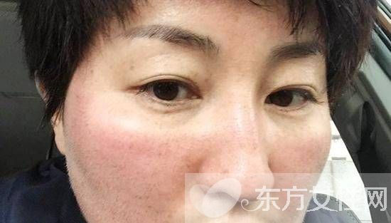 臉部色斑形成的原因 教你在家自制祛斑面膜