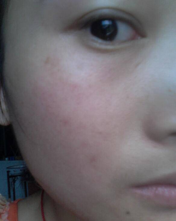 紫外線過敏怎么辦 它有哪些癥狀表現(xiàn)