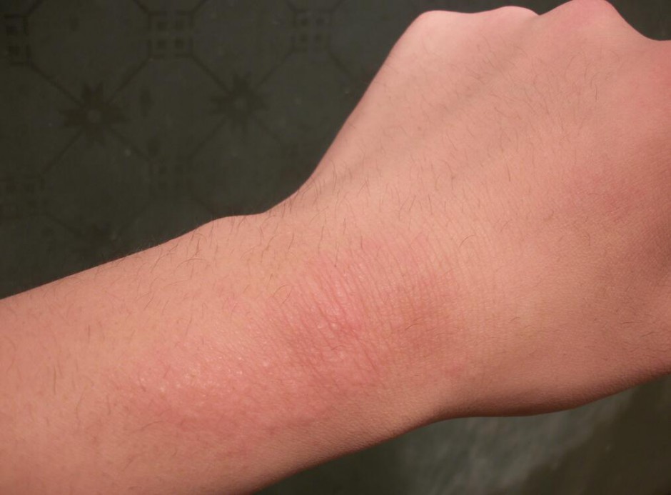 海鮮過敏怎么辦 預(yù)防海鮮過敏的方法