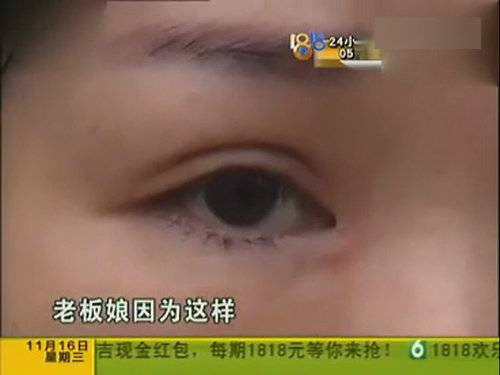 女子整形上班遭拒 割完雙眼皮后眼睛嚇人