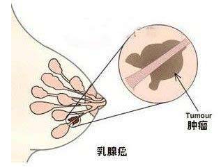 職場女性為什么乳腺癌高發(fā) 我們該如何愛護(hù)乳房