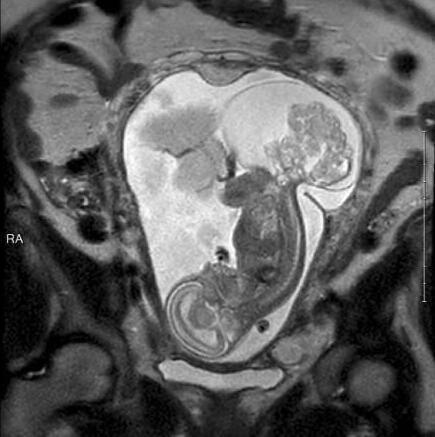 胎兒23周被取出子宮 手術(shù)后放回32周健康出生
