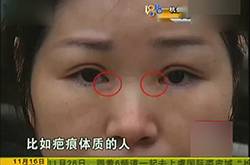 女子整形上班遭拒 割完雙眼皮后眼睛嚇人