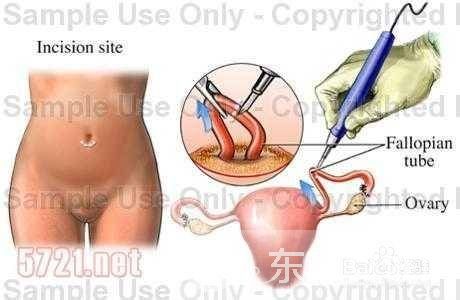 宮外孕怎么辦 宮外孕出血怎么辦