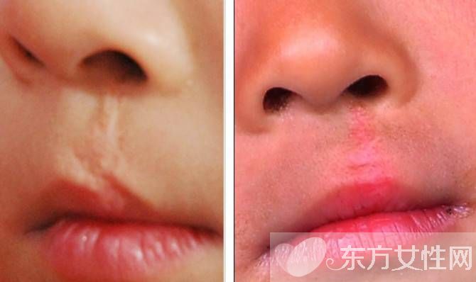 李嫣兔唇原因 李嫣護姐對抗網(wǎng)友獲贊 中國好姐妹