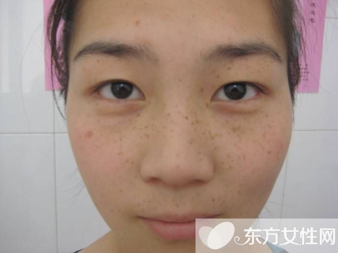 產(chǎn)后黃褐斑怎么去掉 這些方法試過的都說好