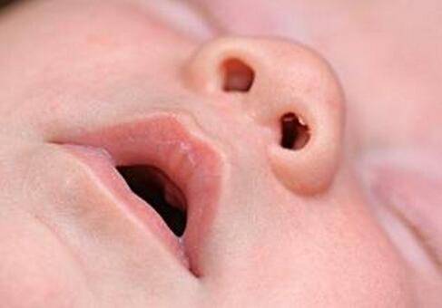 寶寶鼻塞怎么辦 出現(xiàn)這些問題應(yīng)及時就醫(yī)