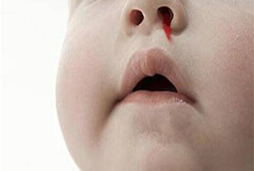 寶寶流鼻血要警惕 可能是白血病惹的禍
