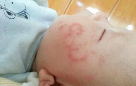 寶寶臉上長廯怎么辦 這些一定要注意