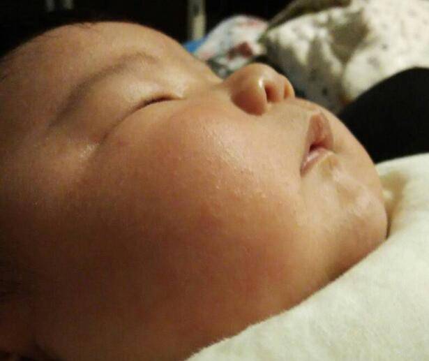 寶寶臉上長廯怎么辦 這些一定要注意