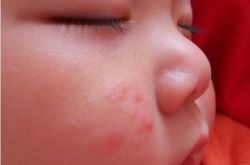 寶寶臉上長(zhǎng)廯怎么辦 這些一定要注意