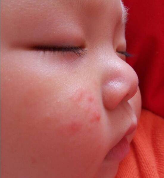 寶寶臉上長廯怎么辦 這些一定要注意