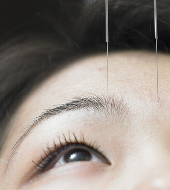 針灸減肥 針灸減肥十大常見問題