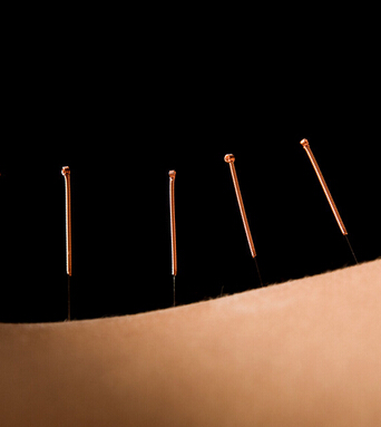 針灸減肥 針灸減肥十大常見問題