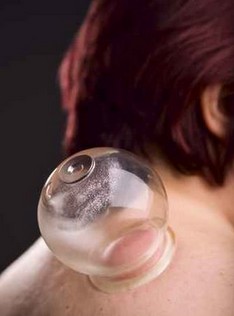 拔火罐拔出水泡 拔火罐起水泡的預(yù)防方法