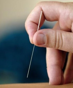 減肥方法 針灸減肥有哪些瘦身穴位