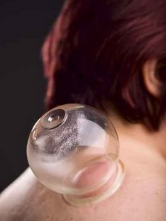 拔罐減肥 拔罐減肥的利與弊