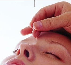 如何進(jìn)行針灸減肥 針灸減肥應(yīng)該注意什么