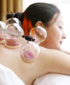 拔罐減肥方法 拔罐減肥的作用和基本操作