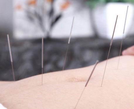 健康減肥 哪些體質(zhì)用針灸減肥肯定能瘦