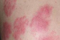 猩紅熱癥狀有哪些呢 患有猩紅熱會(huì)有后遺癥嗎