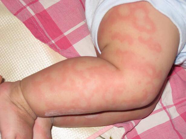 寶寶過敏怎么辦 千萬記住這三點(diǎn)