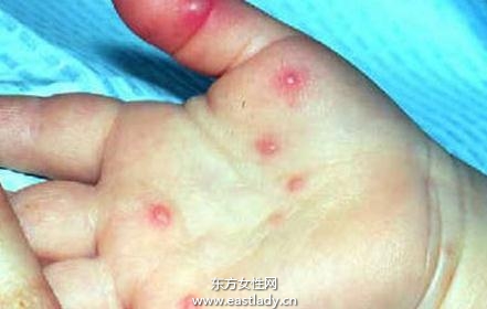 嬰幼兒得皮疹如何護(hù)理