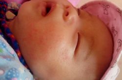 嬰兒奶癬的癥狀表現(xiàn) 這么做可有效預(yù)防奶癬哦