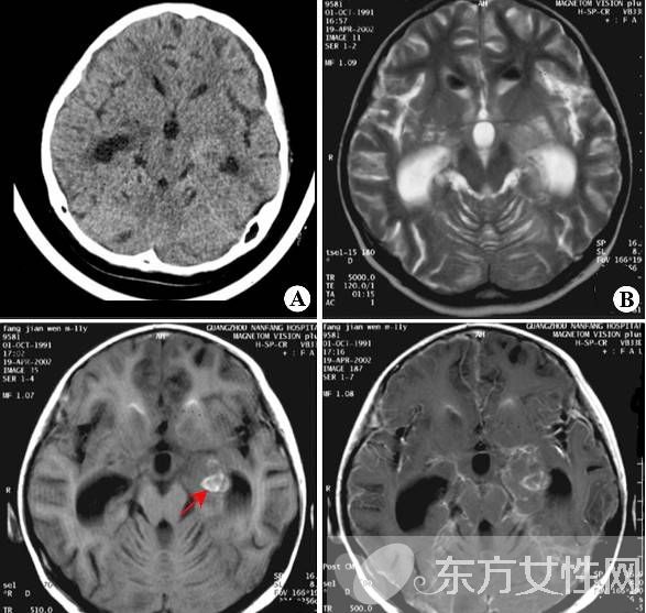 腦膜炎有什么癥狀 腦膜炎是什么原因引起的