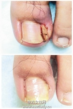 鞋子穿太小男童甲溝炎化膿