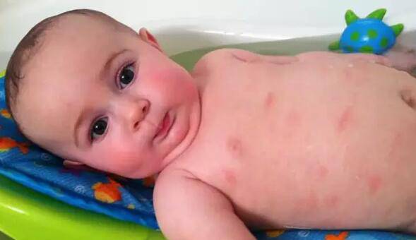 寶寶過敏怎么辦 千萬記住這三點(diǎn)