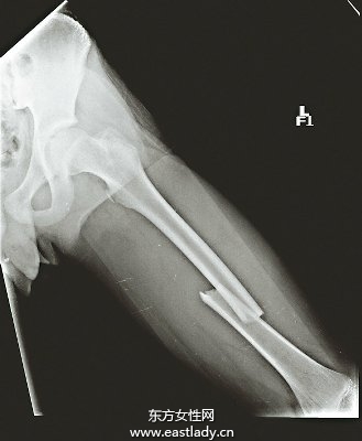 少年1年內(nèi)二次大腿骨骨折 原因居然是...