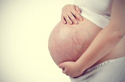 產(chǎn)后如何去掉妊娠紋 這些錯誤方法趕緊改過來