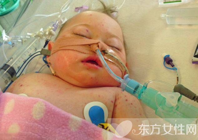 腦膜炎有什么癥狀 腦膜炎是什么原因引起的