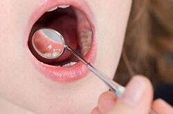 孕婦口腔潰瘍怎么辦 如何巧治孕婦口腔潰瘍