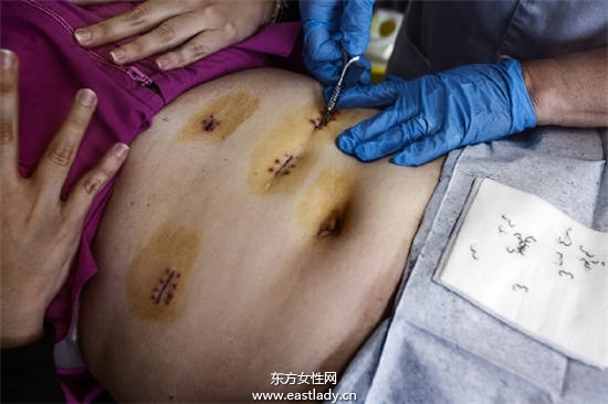 120公斤胖妹做胃繞道減肥手術(shù)暴減50公斤恢復(fù)自信