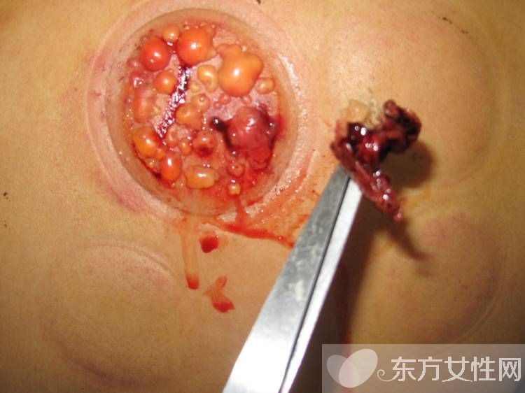 拔火罐減肥的好處與壞處 拔火罐減肥會反彈嗎