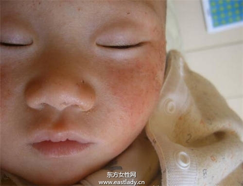 寶寶臉上長小疙瘩媽媽誤以為是痱子 差點(diǎn)給寶寶毀容