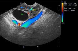 卵巢囊腫的最佳治療 這些不良習慣易得卵巢囊腫哦