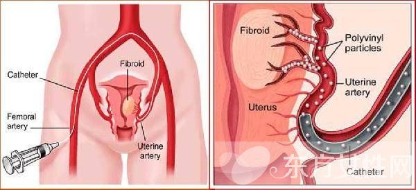 子宮肌瘤的癥狀表現(xiàn) 子宮肌瘤的危害居然這么大