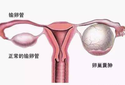 卵巢囊腫的治療方法有哪些 及時就醫(yī)還你一生健康