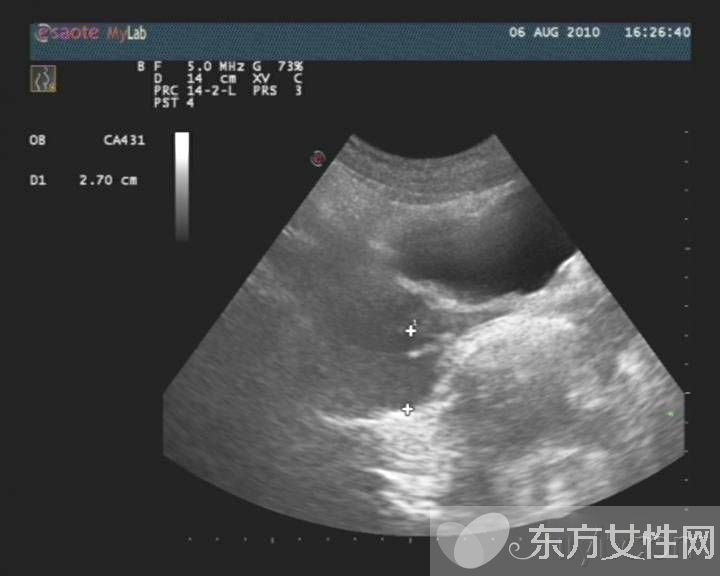 盆腔炎癥狀表現(xiàn)以及治療 盆腔炎的危害居然這么大