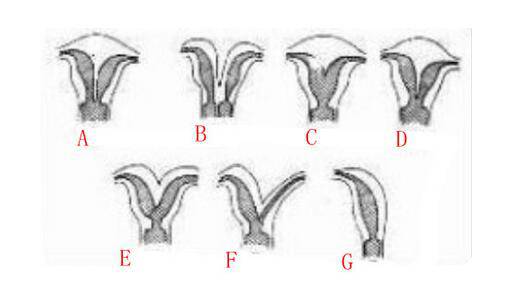 子宮畸形怎么辦 它的危害居然這么大